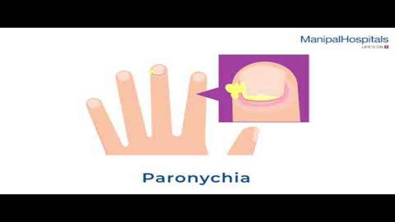 Paronychia Nail Infection | Paronychia Treatment India - Manipal