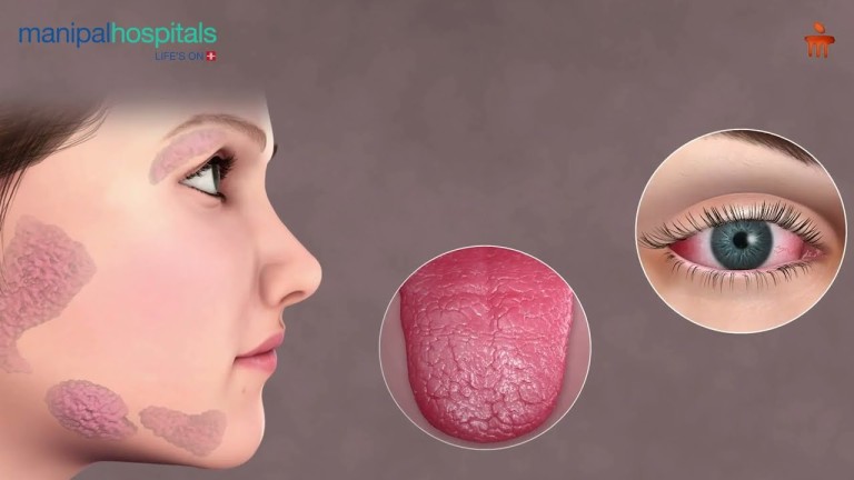 Sjogren’s_Syndrome_Dr__Ashlesha_Shukla_Manipal_Hospital_Bhubaneswar.jpg