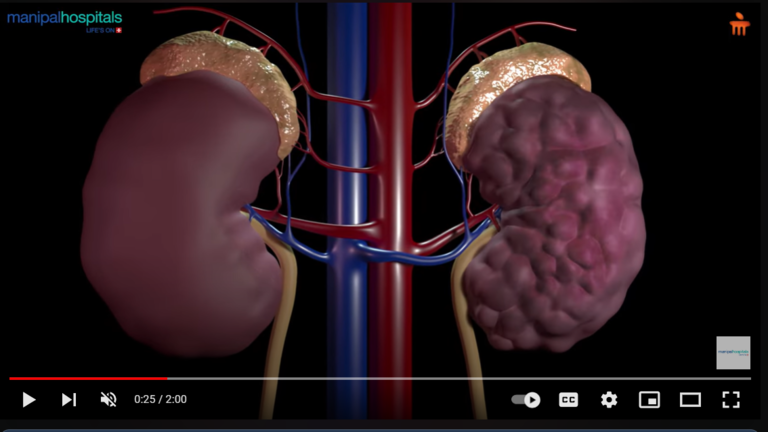 dr-m-sudhakar-rao-on-fistuloplasty.png