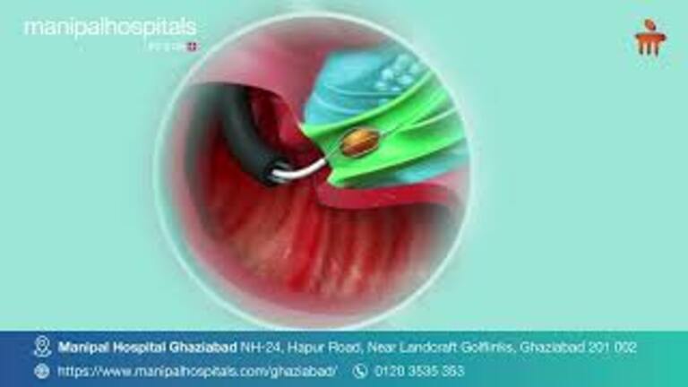gall-bladder-stone-treatment-in-ghaziabad.jpeg