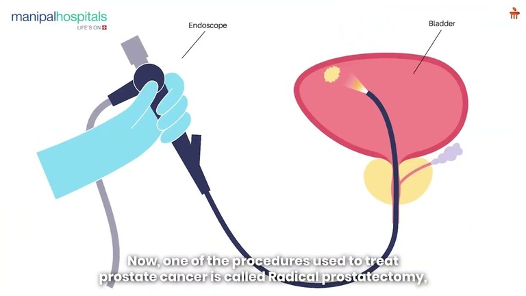 managing-prostate-surgery-side-effects.jpg