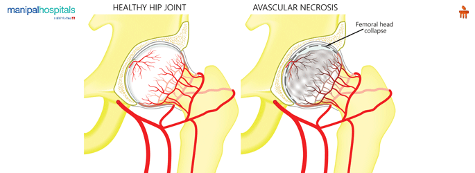Avascular Necrosis of Hip Treatment in Vijayawada