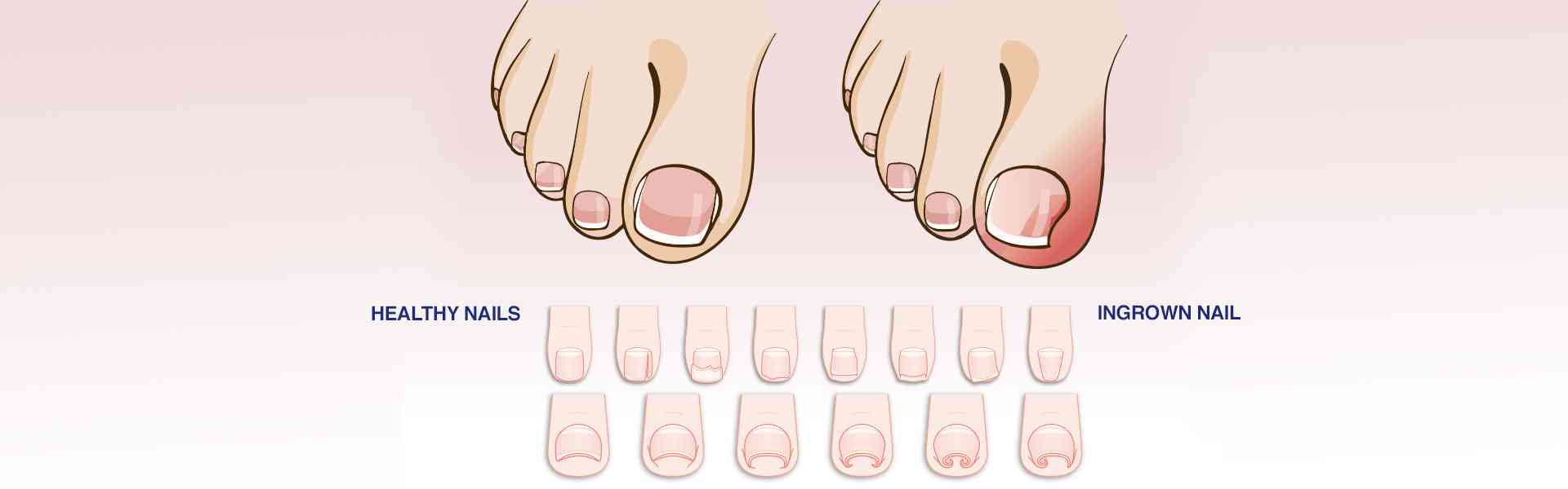 Ingrown Toe Nail Treatment in Vijayawada
