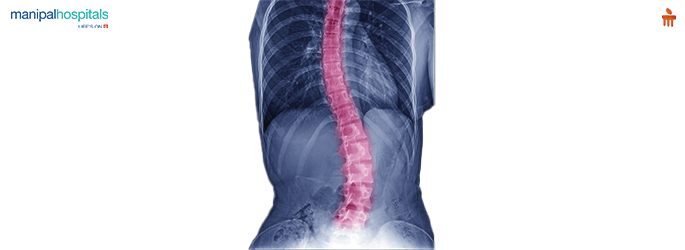 Scoliosis Treatment in Whitefield Bangalore