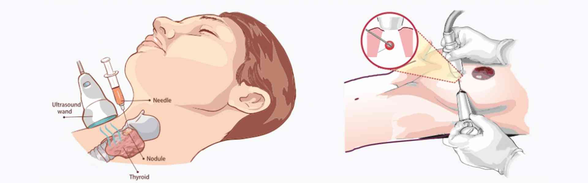Core Biopsy treatment in Whitefield